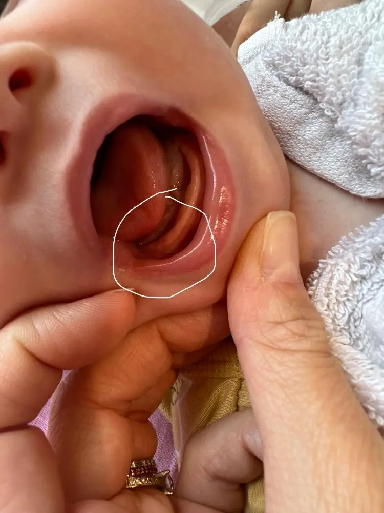 mundfäule babys - Wie fängt Mundfäule an