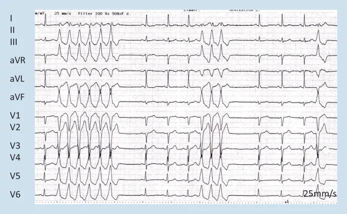 Herzrhythmusstörungen in der Schwangerschaft - Wie fühlt man sich bei Herzrhythmusstörungen herzrhythmusstörungen schwangerschaft - Wie fühlt man sich bei Herzrhythmusstörungen