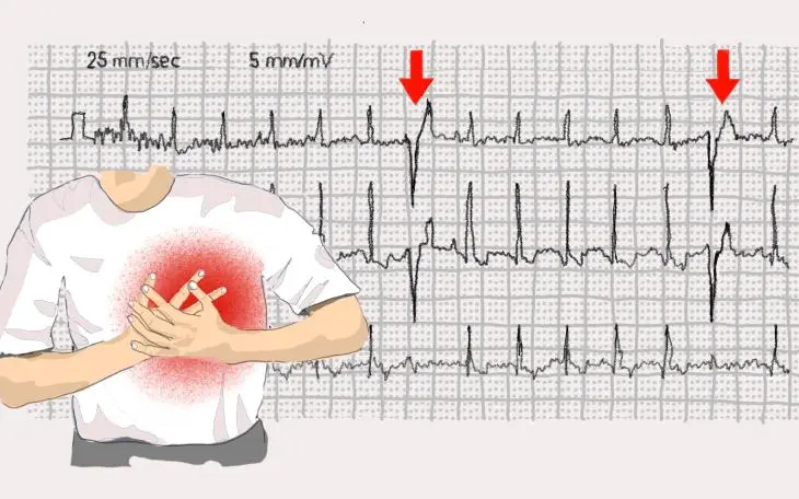 herzstolpern nach geburt - Wie fühlt man sich nach Herzstolpern