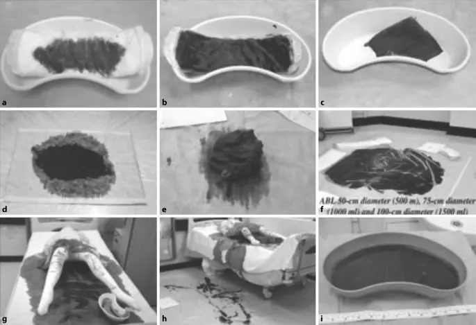 hoher blutverlust geburt folgen - Wie fühlt man sich nach hohem Blutverlust