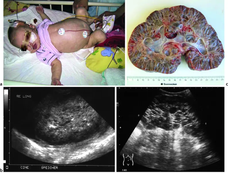 nierenprobleme nach geburt - Wie fühlt sich eine Nierenbeckenentzündung an