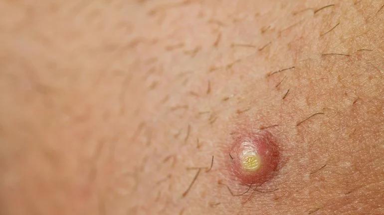 mrsa schwangerschaft - Wie gefährlich ist MRSA für Schwangere