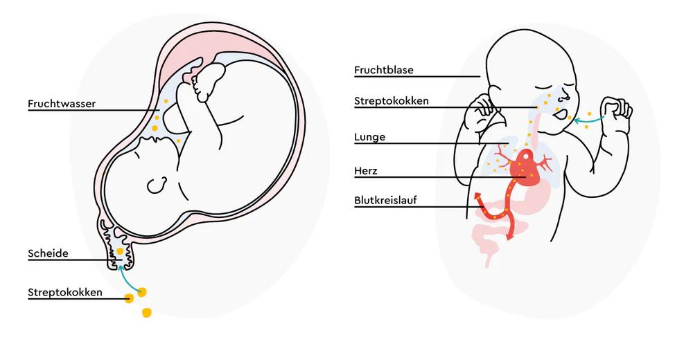 streptokokken geburt - Wie gefährlich sind Streptokokken für Neugeborene