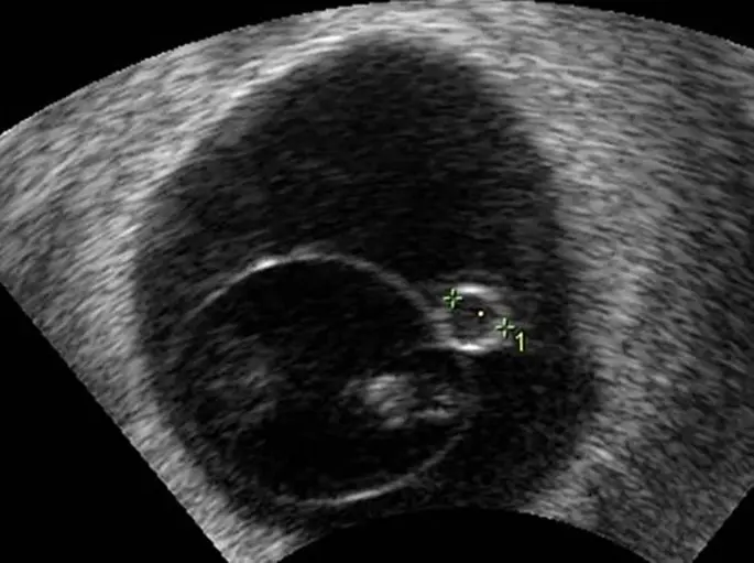 große fruchthöhle gutes zeichen - Wie groß ist der Dottersack in der 6 Woche