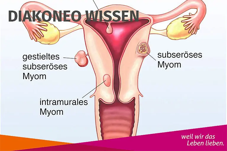 Natürliche Geburt trotz Myom: Ihre Fragen beantwortet - Wie groß kann ein Myom in der Schwangerschaft werden natürliche geburt trotz myom - Wie groß kann ein Myom in der Schwangerschaft werden