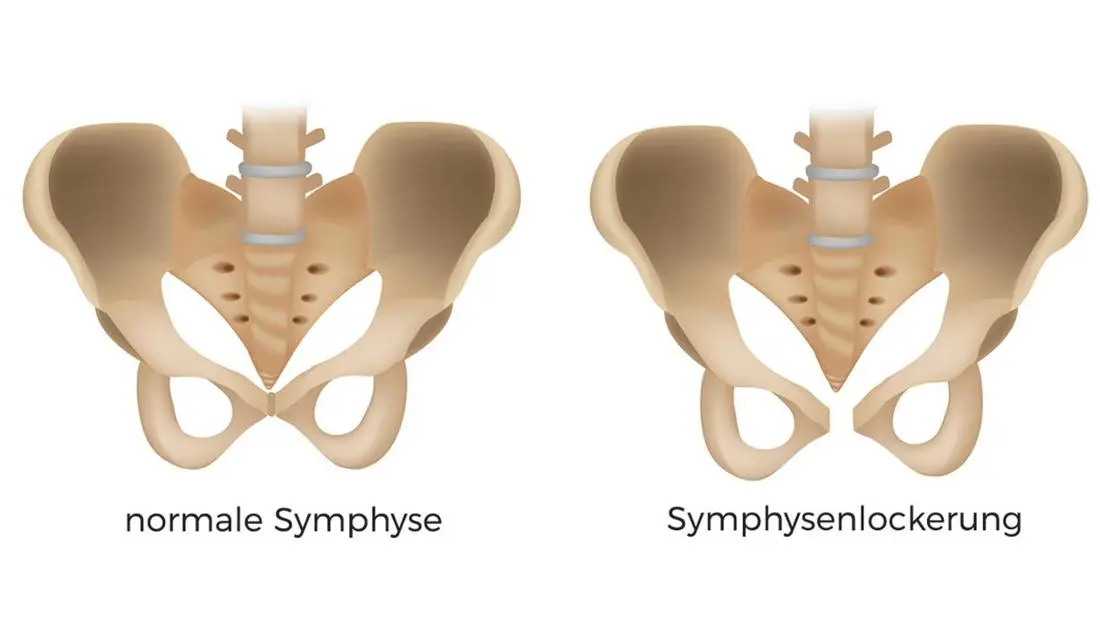 symphysensprengung geburt häufigkeit - Wie häufig Symphysenlockerung
