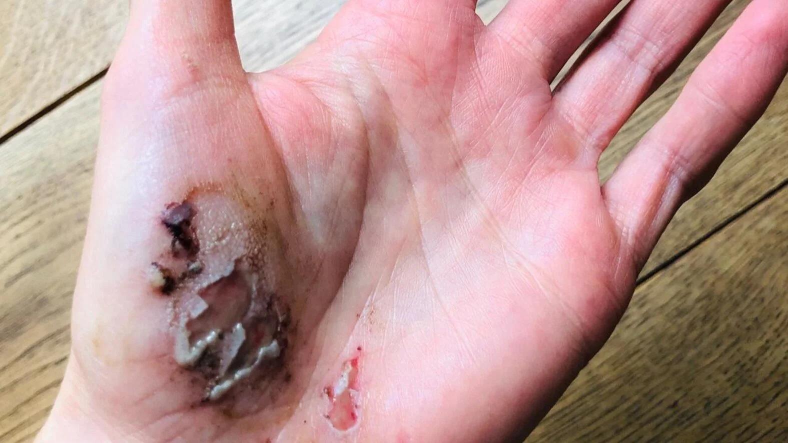 schürfwunden schneller heilen - Wie heilen Schürfwunden am schnellsten