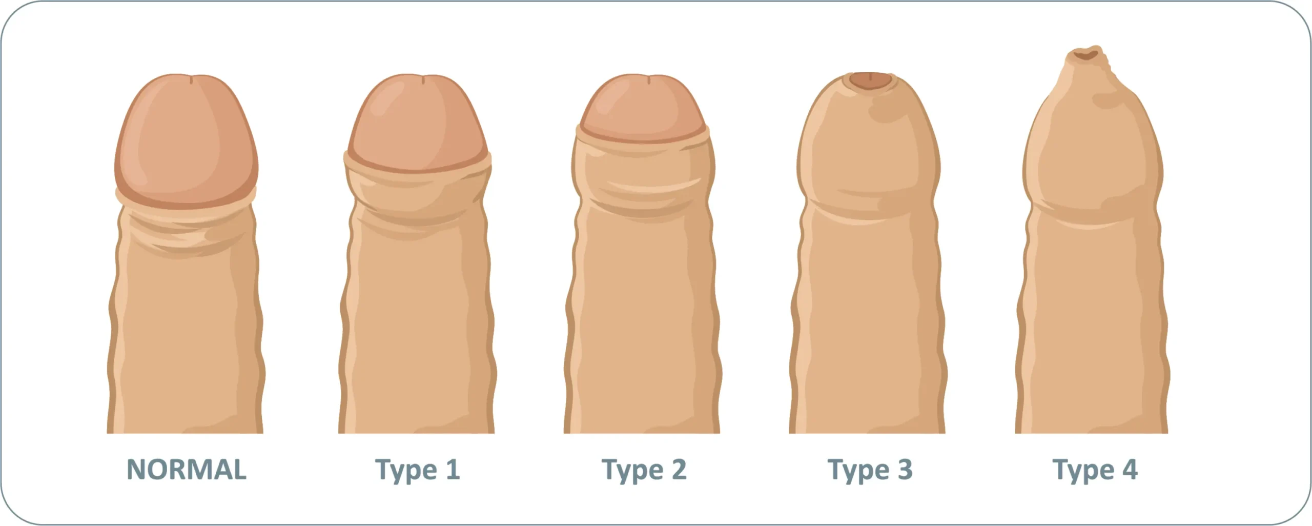 phimose erwachsenen behandeln - Wie heißt die Salbe die hilft bei Phimose