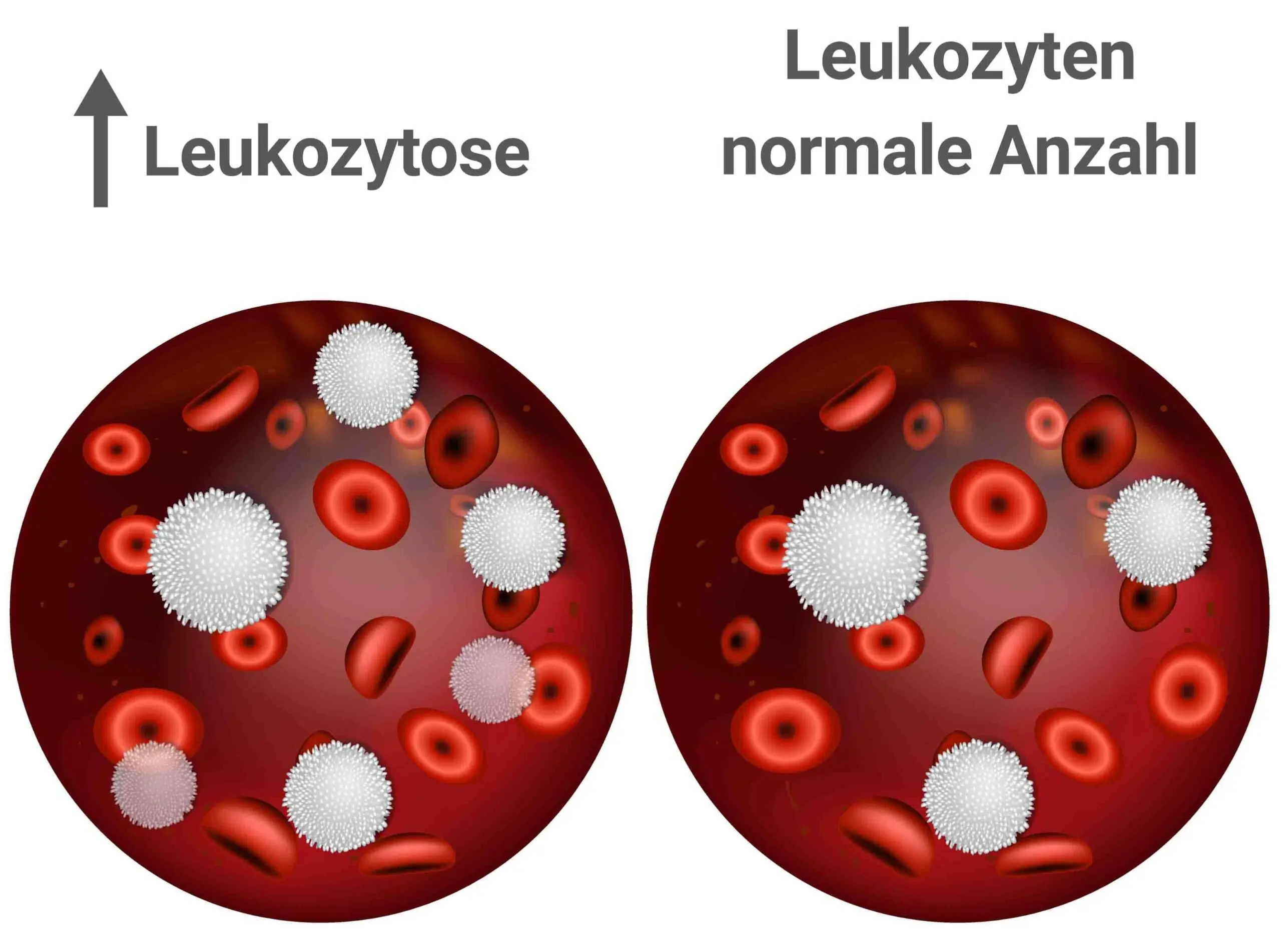 leukozyten erhöht schwangerschaft - Wie hoch dürfen Leukozyten in der Schwangerschaft sein