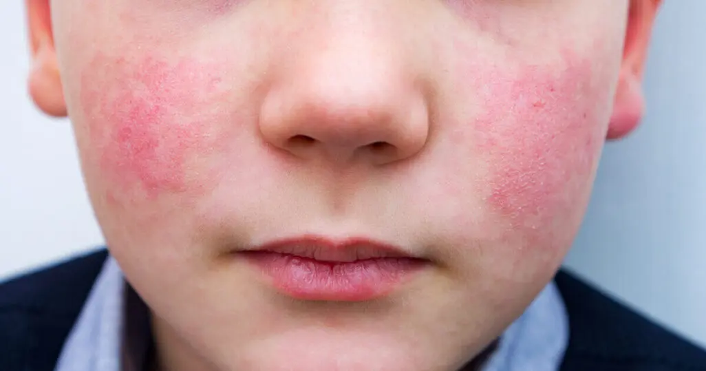 ringelröteln schwangerschaft bis wann gefährlich - Wie hoch ist die Wahrscheinlichkeit Ringelröteln gehabt zu haben