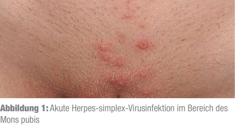 ureaplasmen schwangerschaft erfahrungen - Wie ist der Ausfluss bei Ureaplasmen