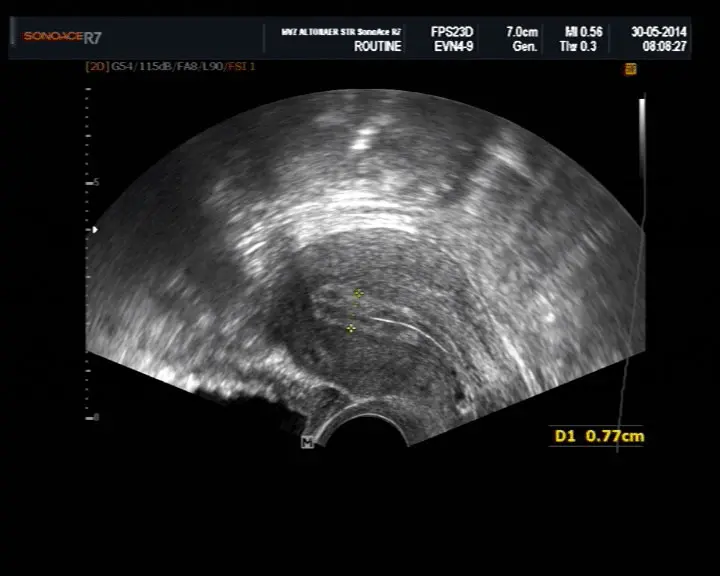 ultraschall gebärmutterschleimhaut schwangerschaft - Wie ist die Gebärmutterschleimhaut in der Frühschwangerschaft