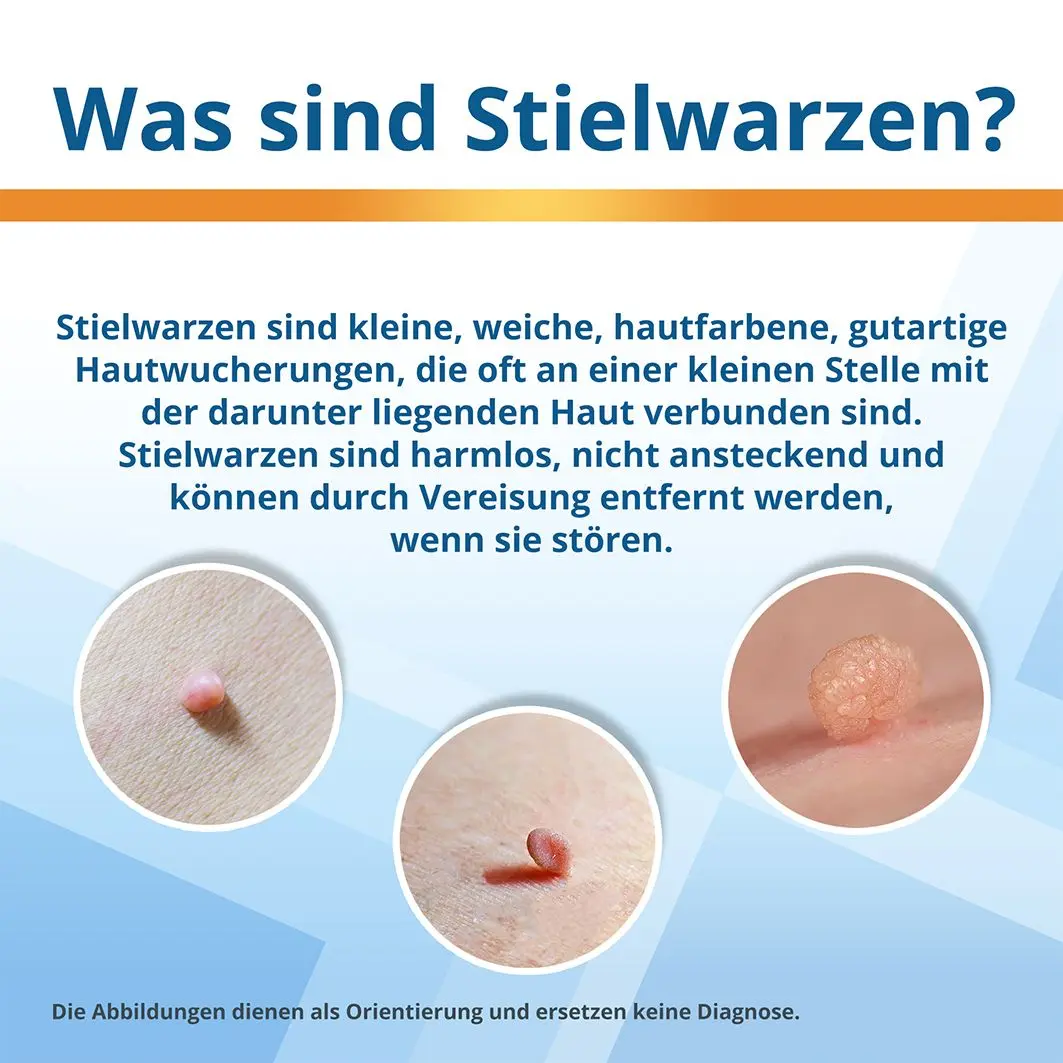 stielwarze schwangerschaft entfernen - Wie kann ich eine Stielwarze selbst entfernen