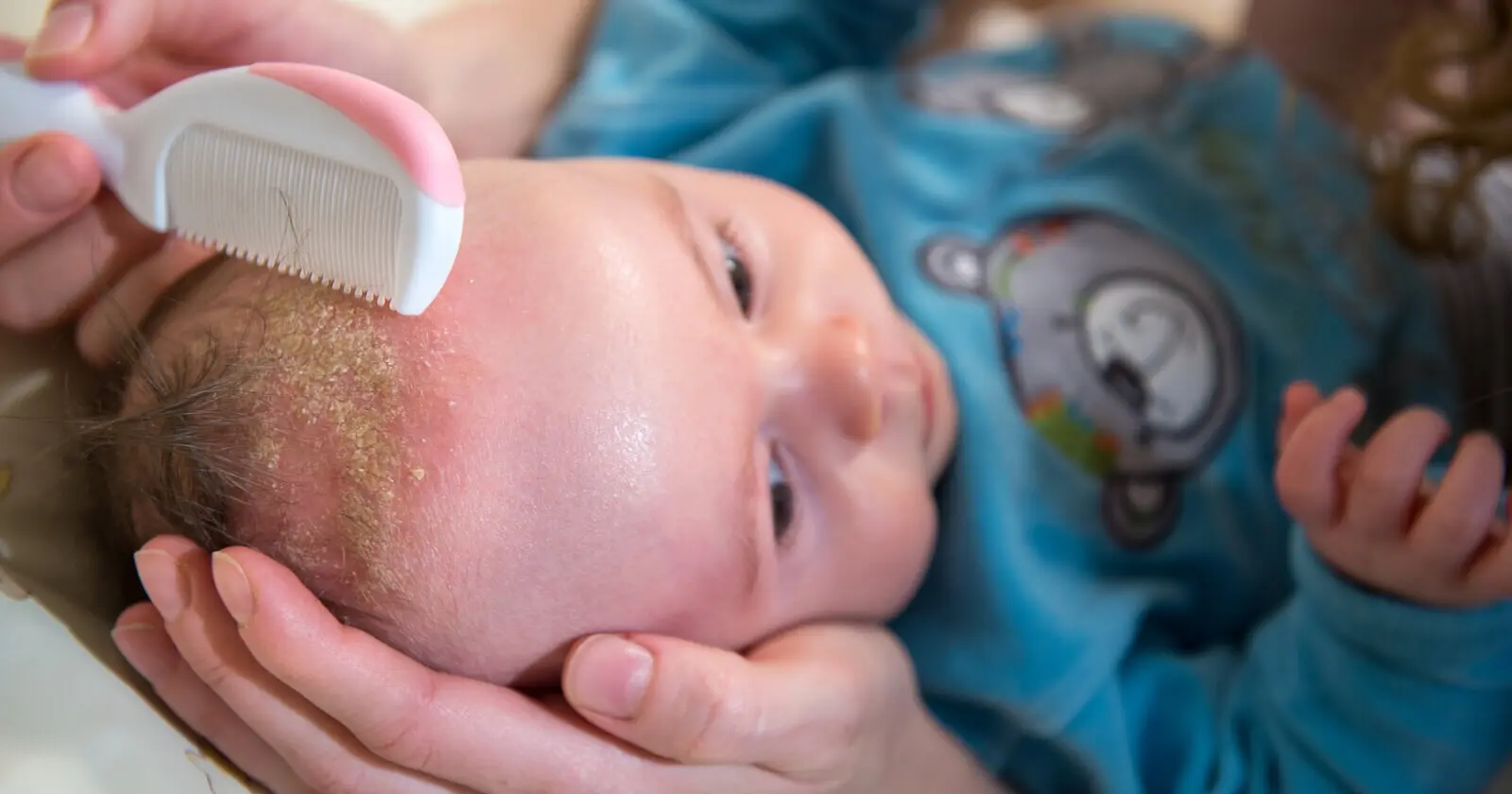 Milchschorf: Ursachen, Behandlung und Vorbeugung - Wie kann ich Milchschorf vorbeugen milchschorf ursachen - Wie kann ich Milchschorf vorbeugen