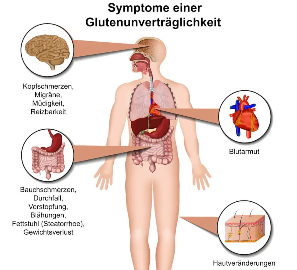 Wie äußert sich eine Glutenunverträglichkeit? - Wie kann man feststellen ob man eine Glutenunverträglichkeit hat wie äußert sich eine glutenunverträglichkeit - Wie kann man feststellen ob man eine Glutenunverträglichkeit hat