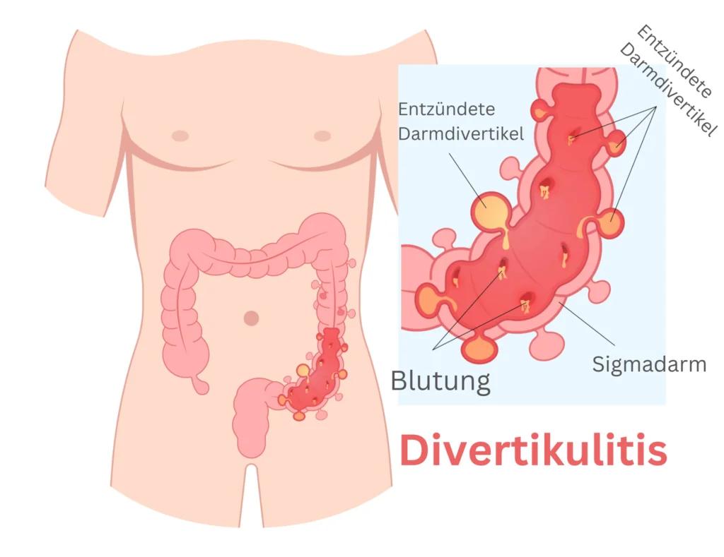 darmdurchbruch erfahrungen - Wie kommt es zu einem Darmdurchbruch
