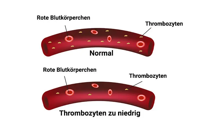 thrombozytose nach geburt - Wie kommt es zu erhöhten Thrombozyten