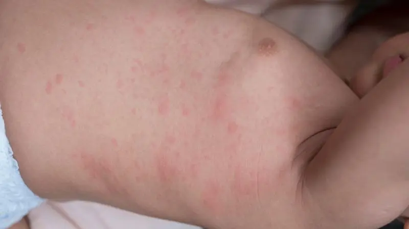 magen-darm ausschlag kleinkind - Wie kündigt sich Magen-Darm an Kleinkind