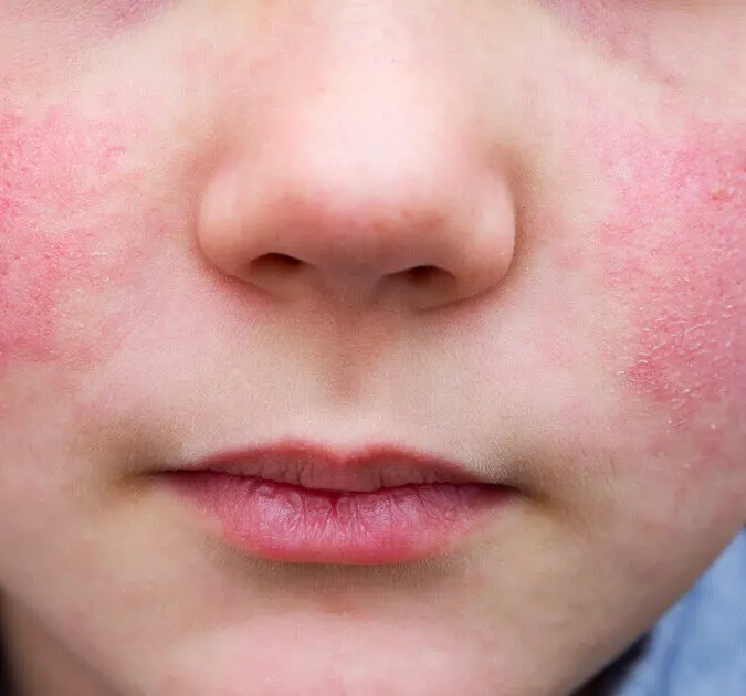 ringelröteln kita schwangerschaft - Wie lange Beschäftigungsverbot bei Ringelröteln