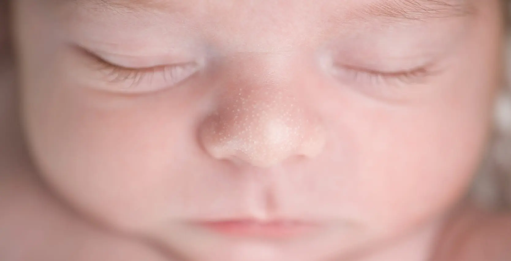 milien bei geburt - Wie lange bleiben Milien bei Neugeborenen