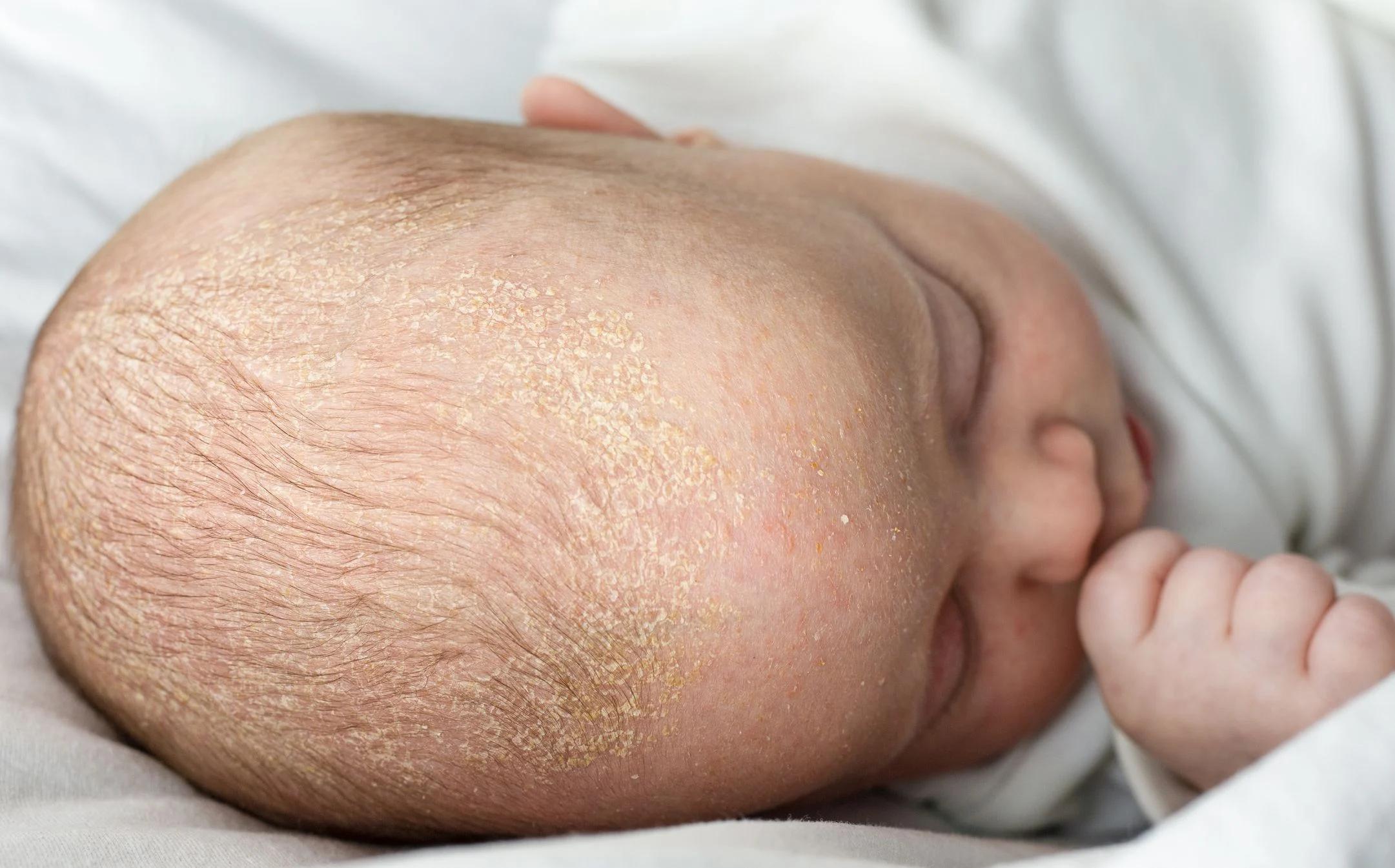baby schorf - Wie lange bleibt der Schorf bei Babys