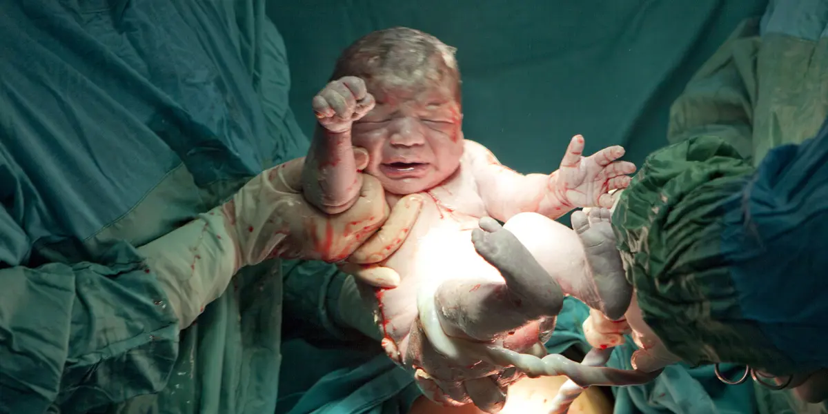 geburt mit kaiserschnitt - Wie lange bleibt man im Krankenhaus nach der Geburt Kaiserschnitt