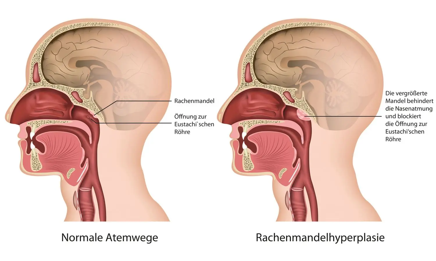 polypen op nase - Wie lange dauert die Heilung nach Polypen OP