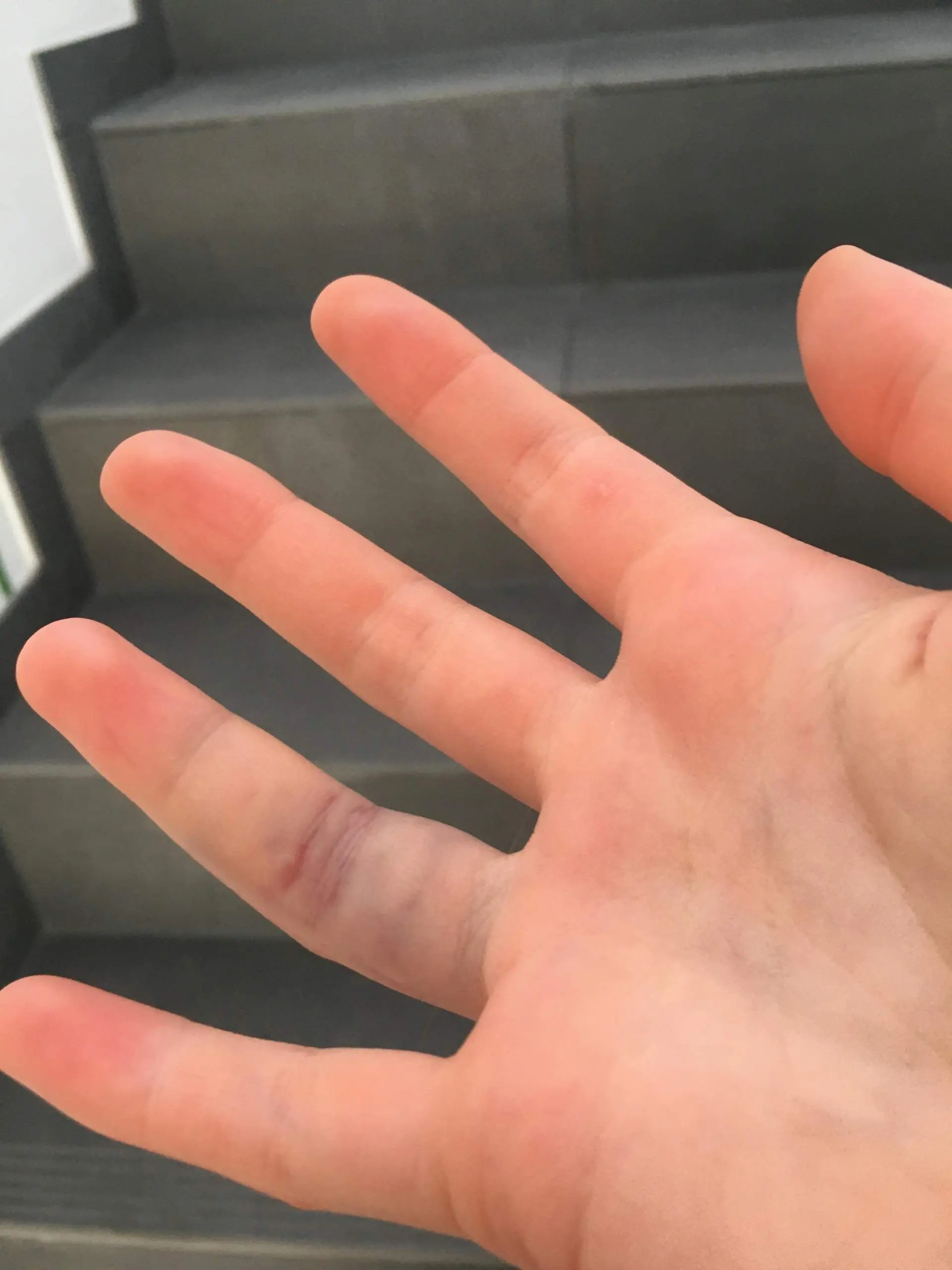 finger prellung - Wie lange dauert eine Fingerprellung