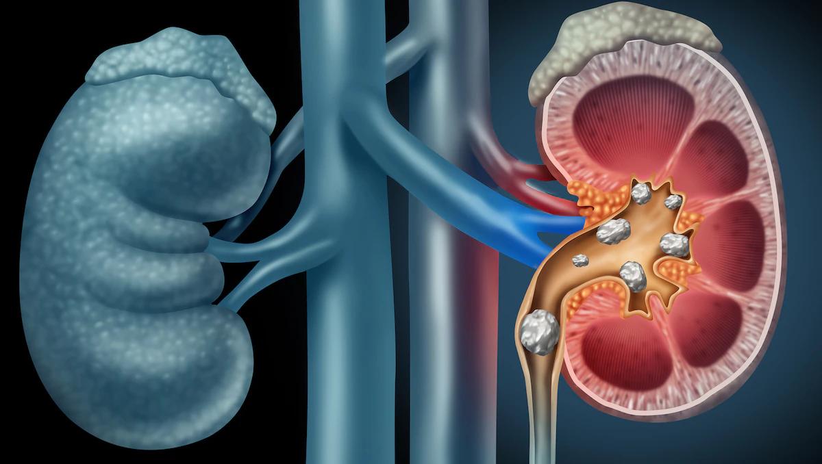 nierenstein-op gefährlich - Wie lange dauert eine OP Nierenstein