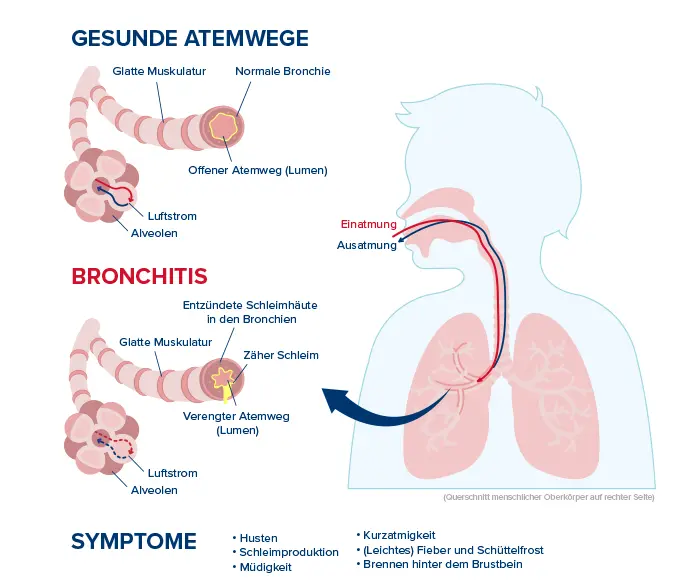 husten spastisch - Wie lange dauert eine spastische Bronchitis an