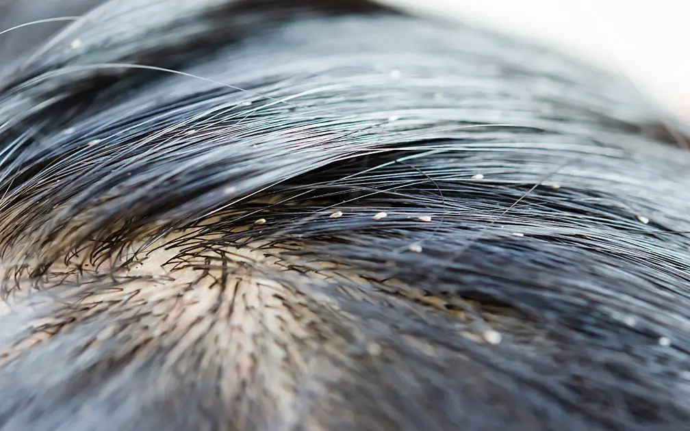 Wie Lange Dauert Es Bis Man Kopfläuse Bemerkt Läusebefall: Wie Viele Sind Normal? | Hebamme FZ