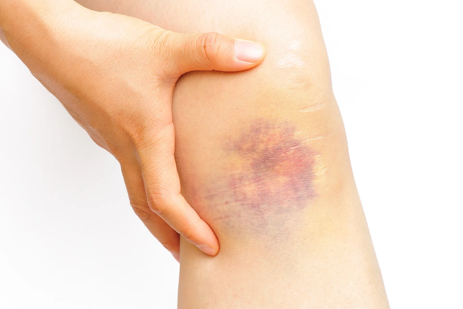 sturz auf knie wie lange schwellung - Wie lange dauert es bis ein Erguss im Knie weg ist