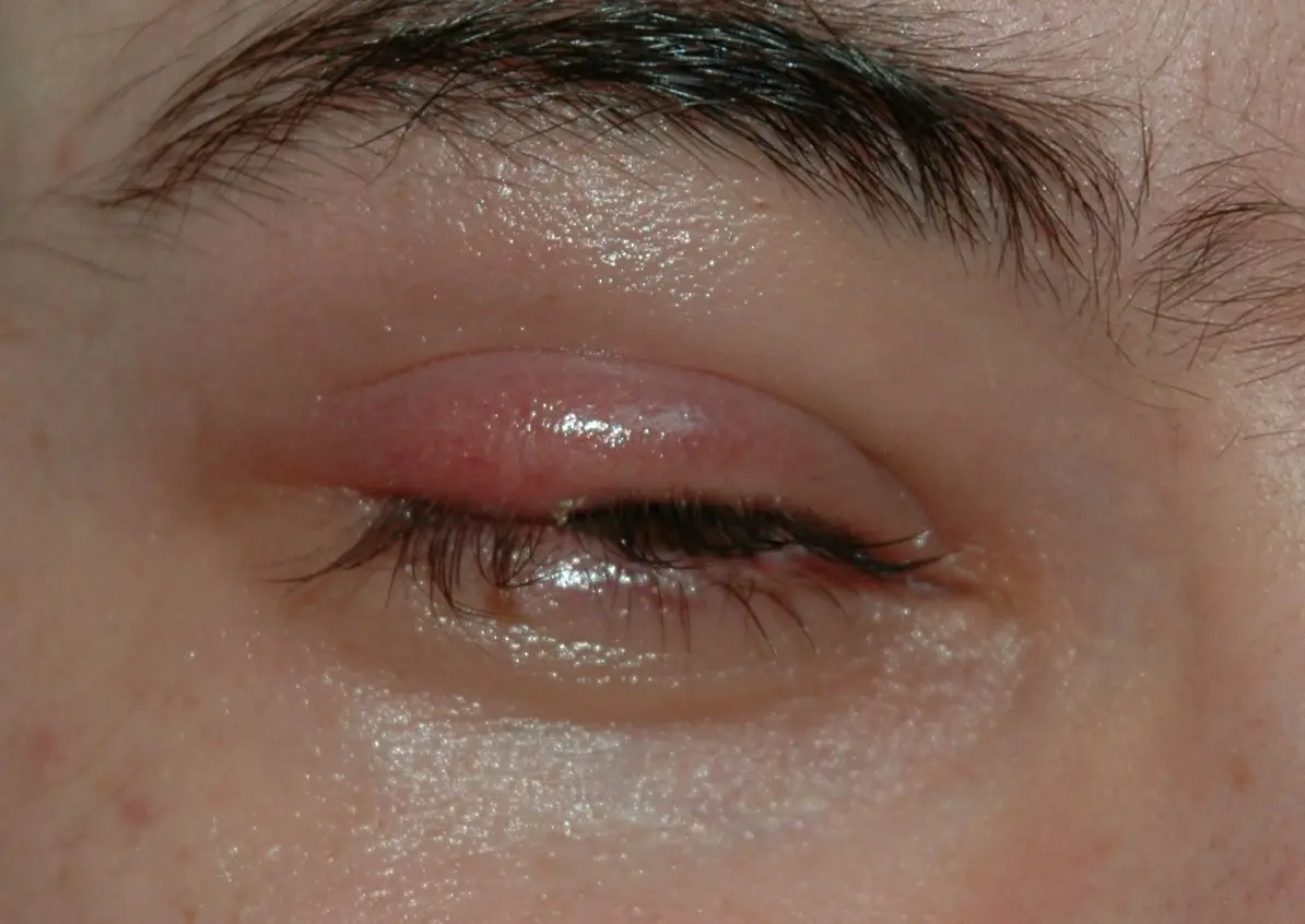 wie fühlt sich ein gerstenkorn an - Wie lange dauert es bis ein Gerstenkorn aufgeht