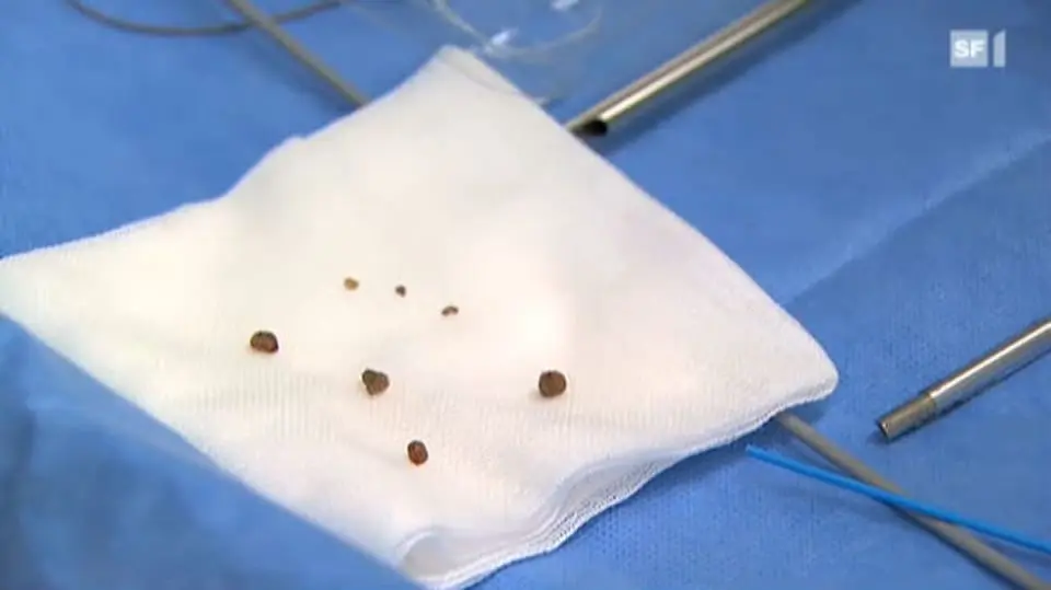 nierensteine nach geburt - Wie lange dauert es bis ein Nierenstein weg ist