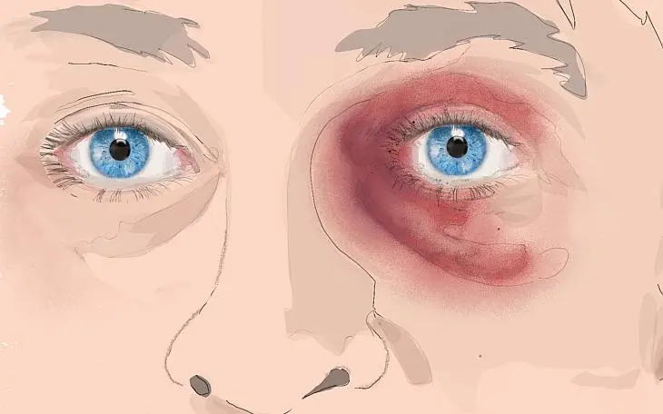 blaues auge verlauf - Wie lange dauert es bis eine Schwellung am Auge zurückgeht