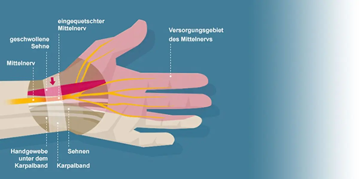 sehnenscheidenentzündung schwangerschaft - Wie lange dauert es bis eine Sehnenscheidenentzündung weg ist