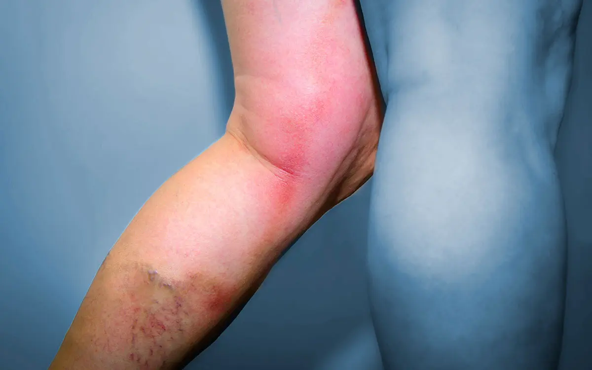 thrombose nach geburt symptome - Wie lange dauert es bis eine Thrombose gefährlich wird