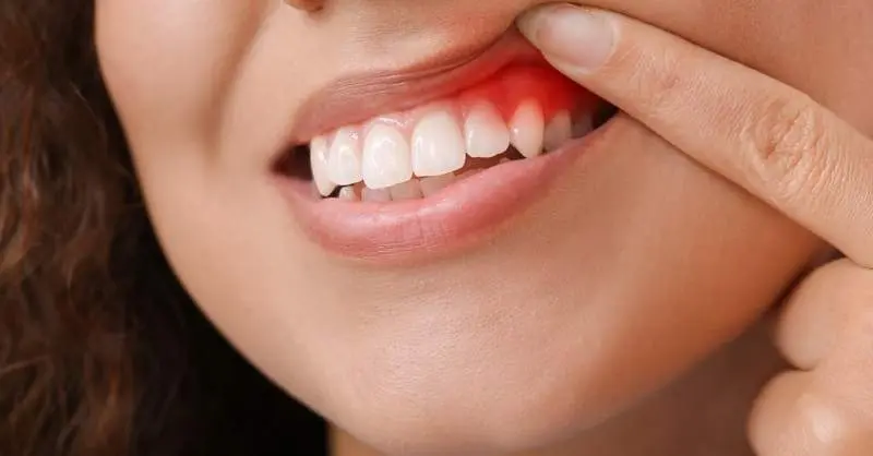 mundfäule - Wie lange dauert es bis Mundfäule weg ist