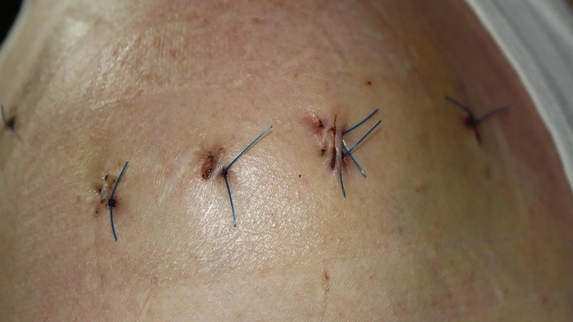 wann lösen sich selbstauflösende fäden auf nach geburt - Wie lange dauert es bis sich selbst auflösende Fäden auflösen