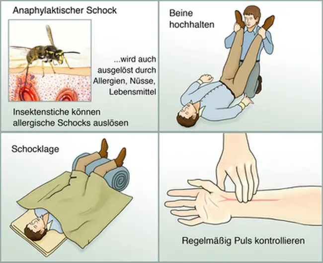 anaphylaktischen - Wie lange dauert es bis zu einem anaphylaktischen Schock