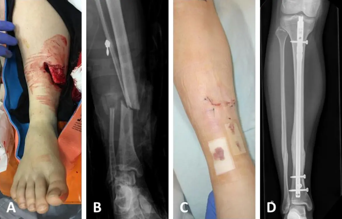 armbruch heilungsdauer - Wie lange dauert es in etwa bis ein gebrochener Arm verheilt ist
