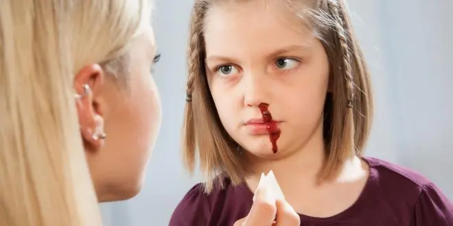 ader veröden nase - Wie lange dauert Heilung nach Verödung Nase