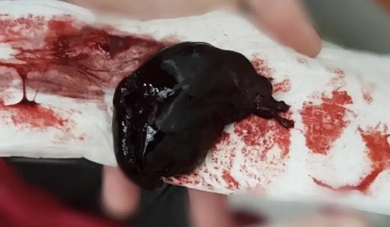 wie lange blutung nach kaiserschnitt - Wie lange dauert Wochenfluss nach Kaiserschnitt Erfahrungen