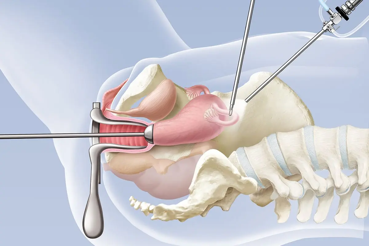 gebärmuttersenkung operation - Wie lange im Krankenhaus nach Gebärmuttersenkung OP