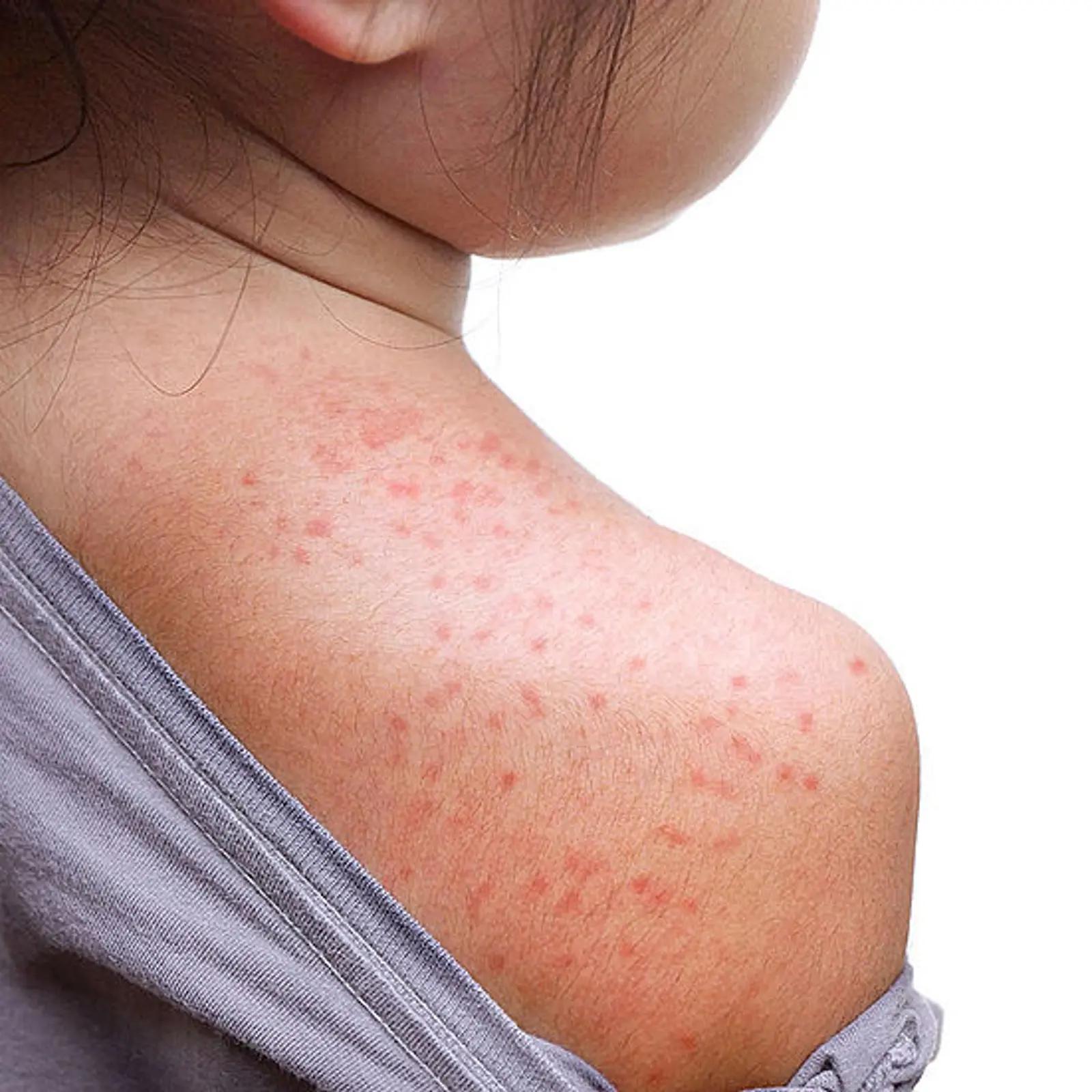 Drei-Tage-Fieber: Wie lange ist ein Kind ansteckend? - Wie lange ist ein Kind mit 3 Tage Fieber ansteckend drei tages fieber wie lange ansteckend - Wie lange ist ein Kind mit 3 Tage Fieber ansteckend