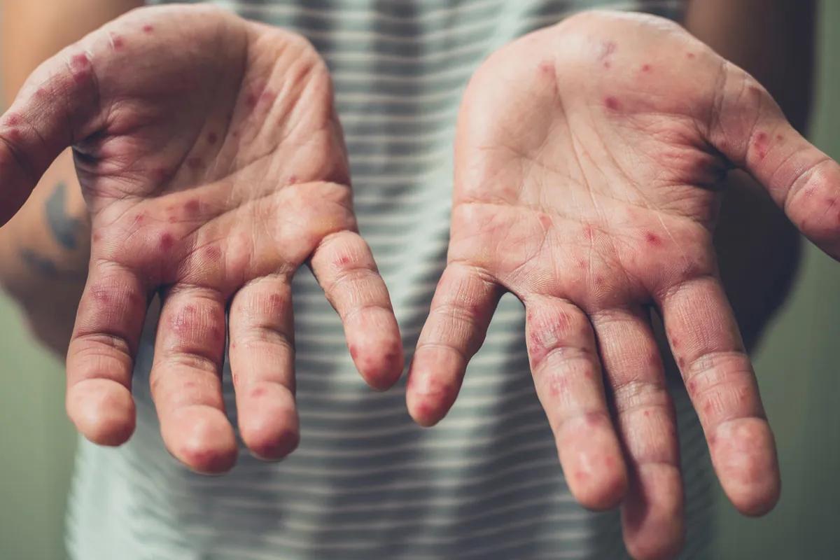 ringelröteln hand - Wie lange jucken Ringelröteln