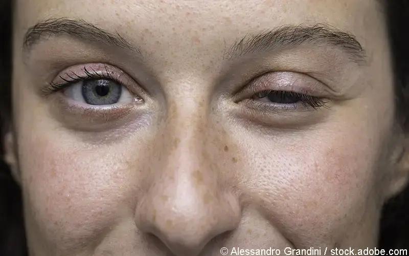 Muskelschwund im Gesicht: Ursachen, Symptome und Behandlung - Wie lange kann man mit Muskelschwund leben muskelschwund gesicht - Wie lange kann man mit Muskelschwund leben