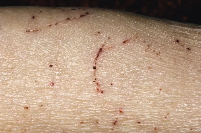 wie lange überlebt krätze in kleidung - Wie lange leben Krätzmilben im Kleiderschrank