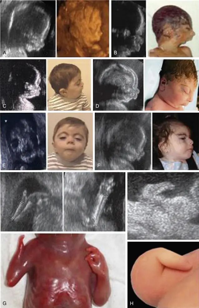 cornelia-de-lange-syndrom schwangerschaft - Wie lange leben Menschen mit CdLS