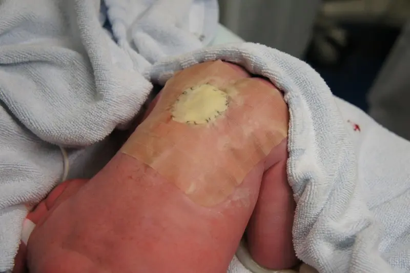 offener ruecken - Wie lange lebt man mit Spina bifida